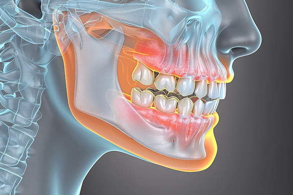 Diagnosed bruxism